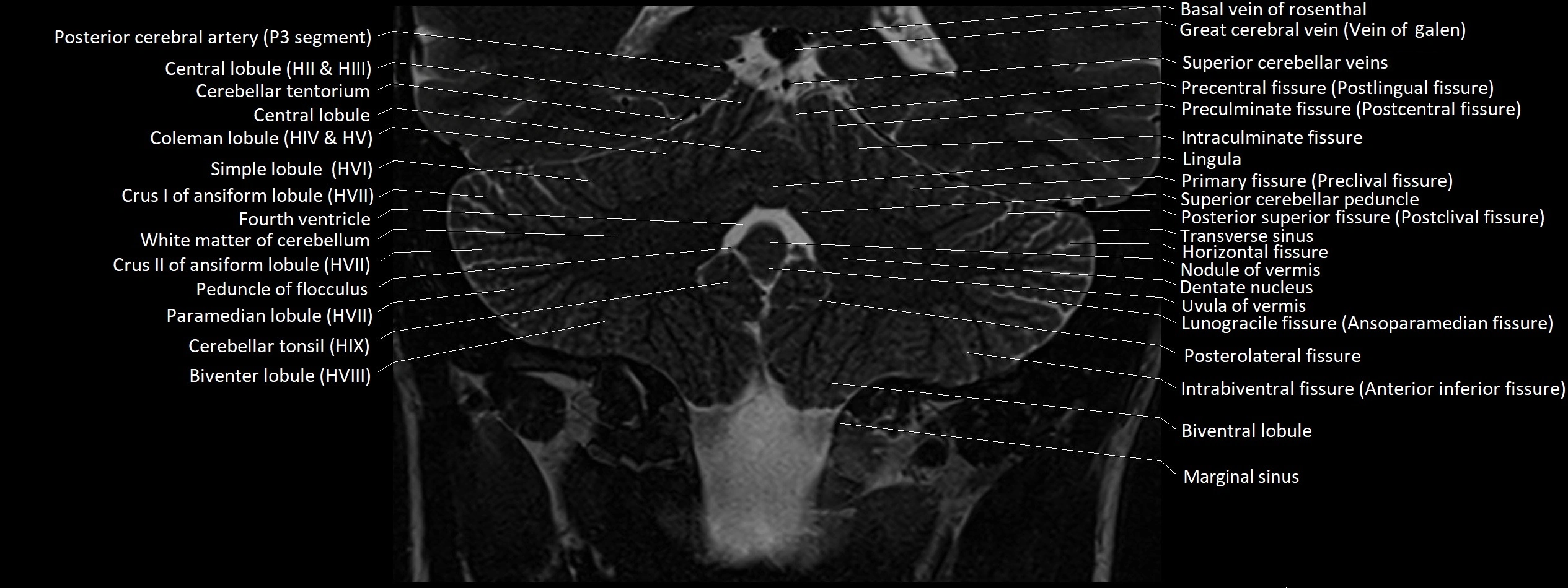 Anatomy of cerebellum coronal cross sectional 3T image 11.webp